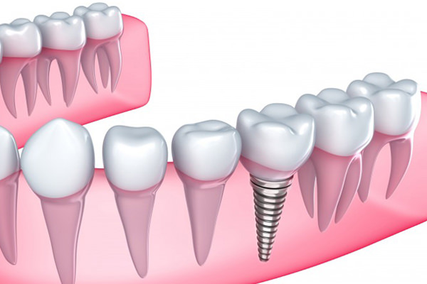 implante-dental-un-solo-dia.jpg
